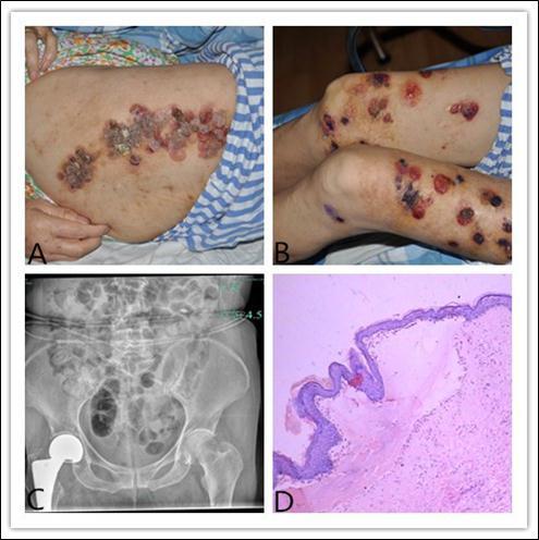 (A) Erythema and blisters on the skin of the right thigh. (B) Multiple tense vesicles, bullae and blood blister on the legs on a background of erythema. (C) The right hip prosthesis made of titanium alloy can be seen by the computed tomography scanning. (D) Histopathology revealed a subepidermal blister (haematoxylin and eosin staining, original magnification x 100).