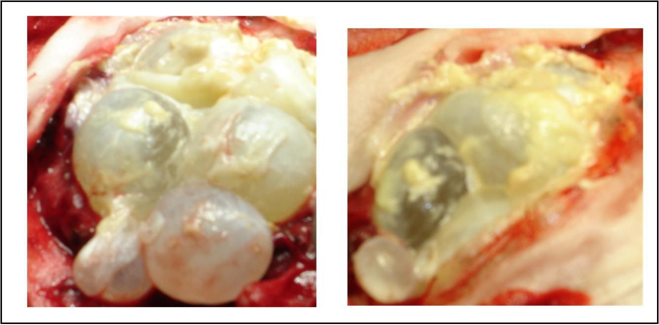 per operative view showing multiple hydatid cysts with purulent material