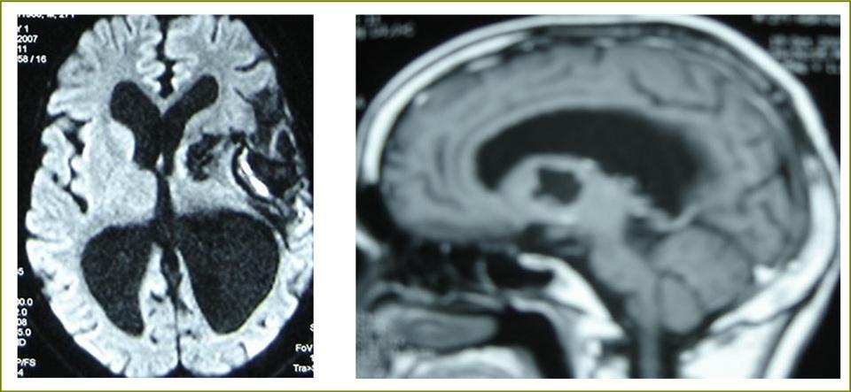 sagittal T1 C+ MRI and axial spectroscopy showing the residual capsule and deep cyst which is less spherical.