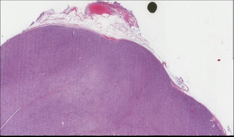 Left thyroid Low power of the thyroid gland showing complete replacement of the thyroid by the neoplastic cells (H&E, ×4).