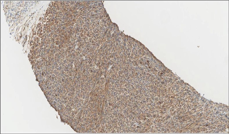 Liver Biopsy IHC of the metastatic foci shows diffuse positivity for Caldesmonstain (IHC,×200).