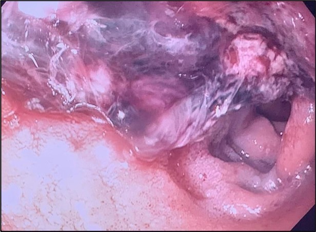 Duodenal ulcer with large adherent clot.