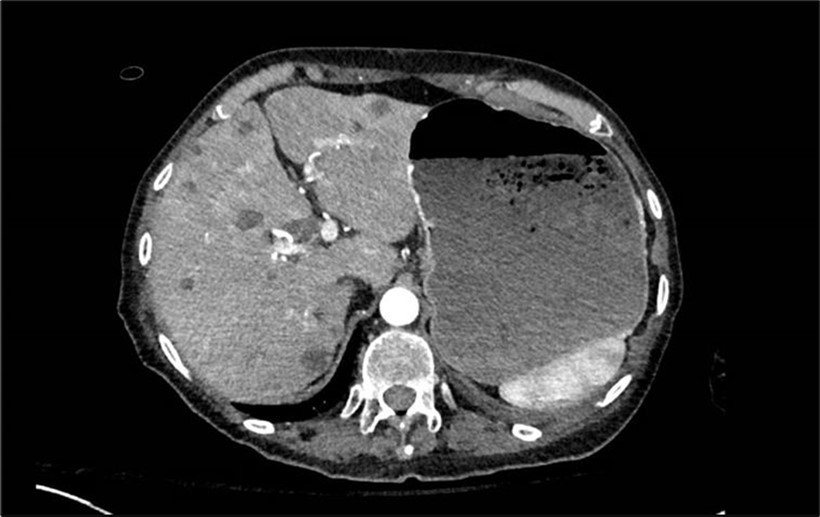CT scan showing liver with multiple metastatic lesions and a large stomach