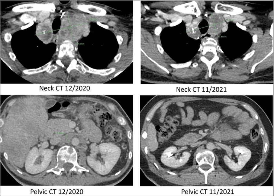 Computed tomography. CT scans of the neck and pelvis with contrast in December of 2020 (prior to Pralsetinib) and in November of 2021 (eleven months after the start of Pralsetinib). The 2020 neck CT showed a large mass at the thoracic inlet measuring 89mm x 50mm. In 2021 this same mass post treatment had decreased in size to 77mm x 41mm. The 2020 pelvic CT showed a retroperitoneal lymph node enlargement to 15mm, which resolved on the 2021 scan.