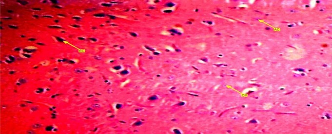 Showed a photomicrograph of anterior pituitary gland of female wister rat treated with progesterone pills for 72 days. It causes decrease in acidophilic and basophilic cells compared with control group. Chomophobes are also in less proportion compared with control group.