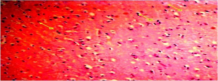 Showed a photomicrograph of anterior pituitary gland of female wister rat treated with combined pills for 72 days. It causes decrease in acidophilic and basophilic cells compared with control group. Chomophobes are also in less proportion compared with control group. Those in this group tend to have more decreased cells.
