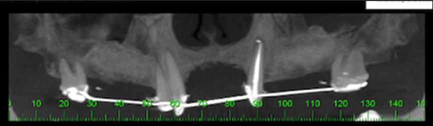 CBCT showing presence a significant bone defect of the pre-maxilla.