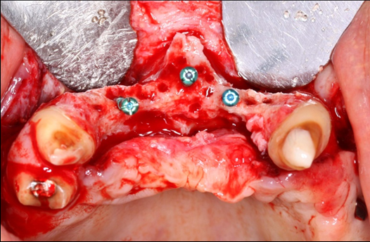 Occlusal view of the pre-maxilla after elevation of amucoperiosteal flap. Noteright and left pre-maxilla buccal plate concavities due to severely resorbed ridge. The central tenting screw is located mid-way into the nasal spine.