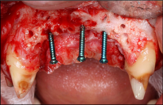 Frontal view of the pre-maxilla after elevation of amucoperiosteal flap. Note 6-8 mm of the tenting screws length are exposed.