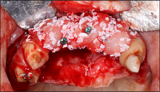 Occlusal view of the pre-maxilla after placement of strips of the rhBMP-2/ACS added to the natural bone mineral component derived from bovine bone.