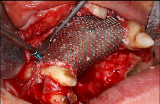 Perspective view of the pre-maxilla showing a titanium mesh adapted over the entire rhBMP-2/ACS graft and fixed with 2monocortical screws, one on thebuccalaspect and oneon the palatal aspect of the ridge, respecting a 2 mm distance form the mesh to the adjacent teeth