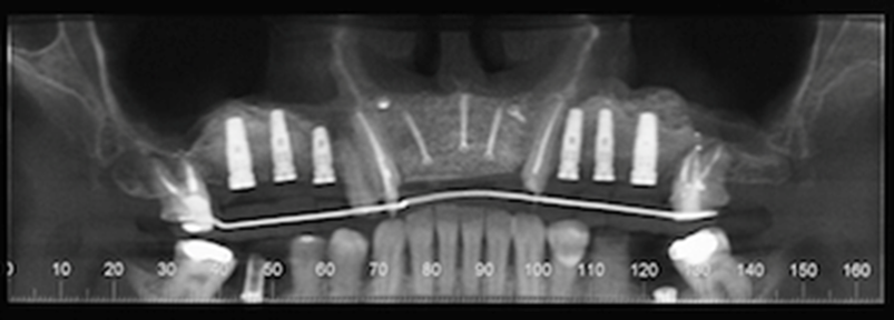 CBCT scan 8 months post ridge augmentation. Note significant increase in bone augmentation of the pre-maxilla. Presence of implants for sites #2, 3, 4, 11, 12 and 13 after right and left sinus lifts were performed.