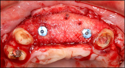 Re-entry at 8-monthspost-op shows a clinically significantly augmented maxilla. Occlusal viewshows implants (Biomet 3I certain®, USA) # 7 and 10 placed.