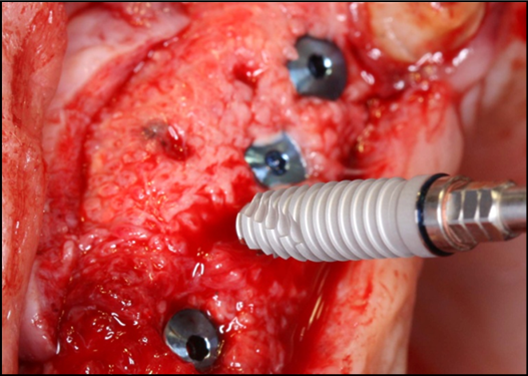 Perspective view of the augmented pre-maxilla with implants(Biomet 3I certain®, USA) #7, 9, 10placed. and #8 beingplaced.