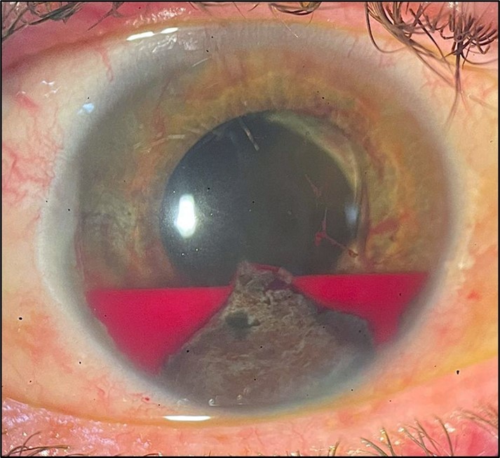 Intraocular lens anterior subluxation associated with organized hyphema and anterior iris synechia.
