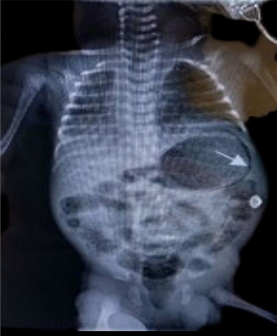 Anterior posterior abdominal radiograph showing gastric pneumatosis (arrow shown) and pneumatosis intestinalis.