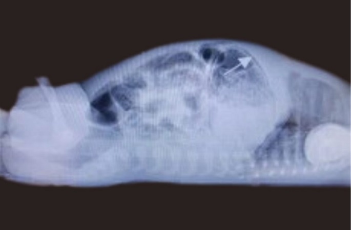 Cross table lateral radiograph showing gastric pneumatosis (arrow shown)