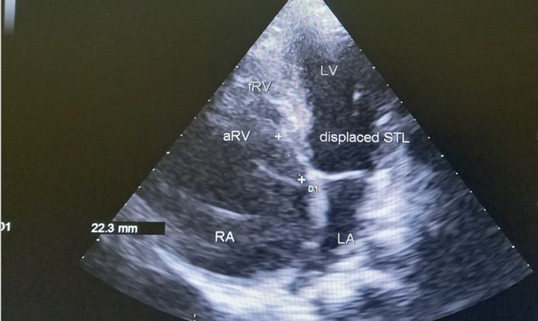 Transthoracic echocardiography, apical four chambers view . Apical displacement of the tricuspid valve (a) and right atrial thrombus (b).