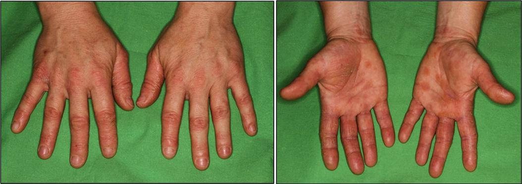a-b Contact dermatitis on the hand provoked by nursing the lavender plant of a 55 year old female patient (patient no. 5).