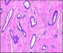 Tubular carcinoma delineating tubules layered by cuboidal to columnar epithelial cells impregnated with miniature to intermediate nuclei, apical snouts and surrounding desmoplastic stroma 7.