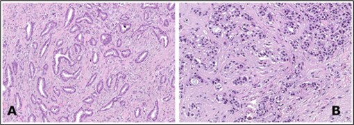 Tubular carcinoma delineating cords and cellular tubules lined by cuboidal to columnar epithelial cells imbued with miniature to intermediate nuclei, apical snouts and surrounding desmoplastic stroma 8.
