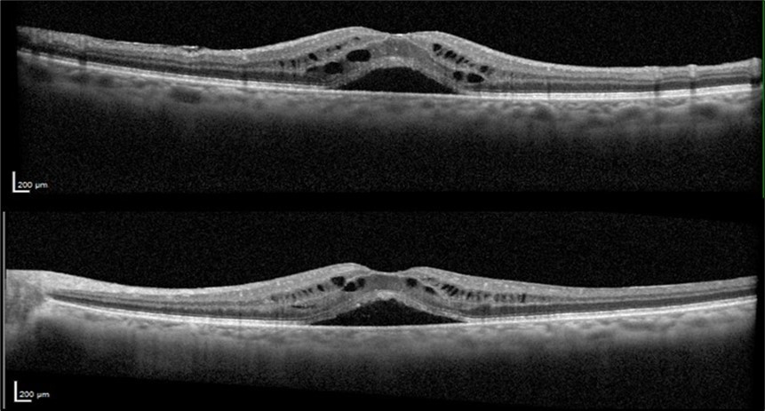 Optical coherence tomography of both eyes revealing subretinal foveal fluid and intraretinal cysts at the patient's initial presentation to our clinic.