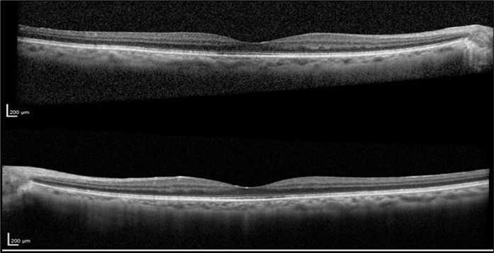 Optical coherence tomography of both eyes revealing the sustained resolution of the cystoid macular edema after Leflunomide discontinuation.
