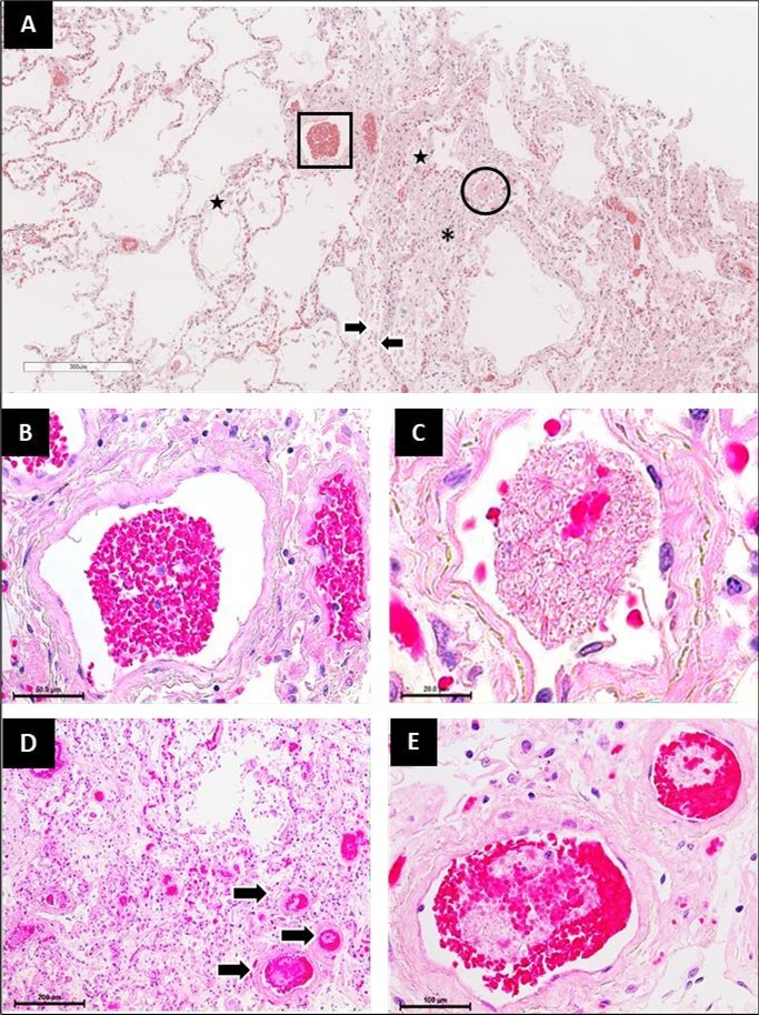 Fibrin thrombi in areas of minimal and severe damage in the lungs of patients who died of SARS-CoV-2 infection. (A) Panoramic micrograph showing a patchy pattern with areas of minimal (left) and severe (right) damage, separated by the interlobular septum (arrows). The square highlights a normal blood vessel (left), while the circle highlights a blood vessel with a fibrin embolus (right). Stars indicate alveolar spaces containing alveolar macrophages and pneumocyte detachment. The asterisk indicates areas of inflammatory infiltrate and interstitial thickening. (B, C) Magnification of the blood vessels highlighted in A. (D) Micrograph showing multiple blood vessels containing fibrin emboli (arrows). (E) Magnification of a vessel revealing the structure of a fibrin embolus. Hematoxylin and eosin staining. Magnifications: A panoramic micrograph was obtained using an Aperio CS2-Digital Pathology Slide Scanner. B, 40x; C, 100x; D, 10x; E, 40x.