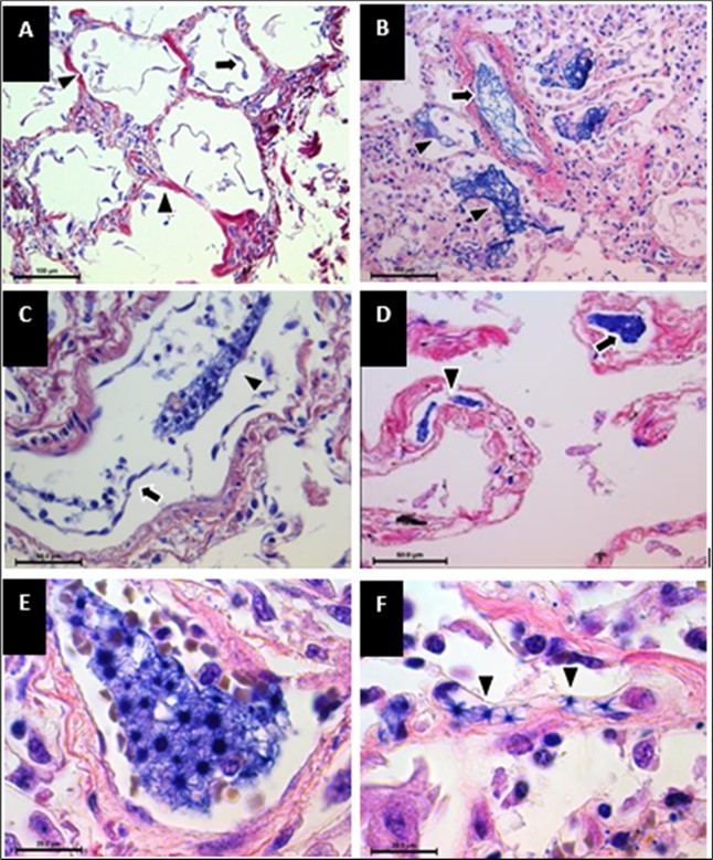 Fibrin thrombi in the lungs of patients who died of SARS-CoV-2 infection Tissue sections stained with phosphotungstic acid hematoxylin revealed diffuse alveolar damage (DAD) and thromboembolism in various anatomical locations. (A) Hyaline membranes (arrowhead) and pneumocyte detachment (arrow). (B) Thrombus in the arteriole (arrow) and intra-alveolar fibrin deposition (arrowheads). (C) Endothelial cell detachment (arrow) and fibrin embolus (arrowhead) in the arterioles. (D) Fibrin thrombi in the arterioles (arrow) and pulmonary capillaries (arrowhead). (E) Star-shaped fibrin structure in the arterioles. (F) Star-shaped fibrin structures in the pulmonary capillaries (arrowheads). Phosphotungstic acid hematoxylin staining. Magnifications: (A, B) 20x; (C, D) 40x; (E, F) 100x.