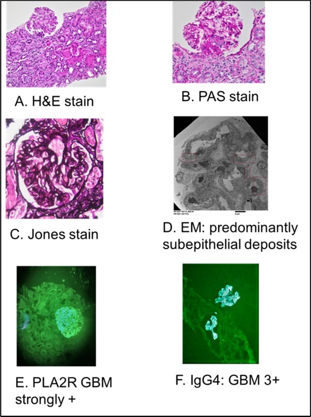 Renal biopsy pathology