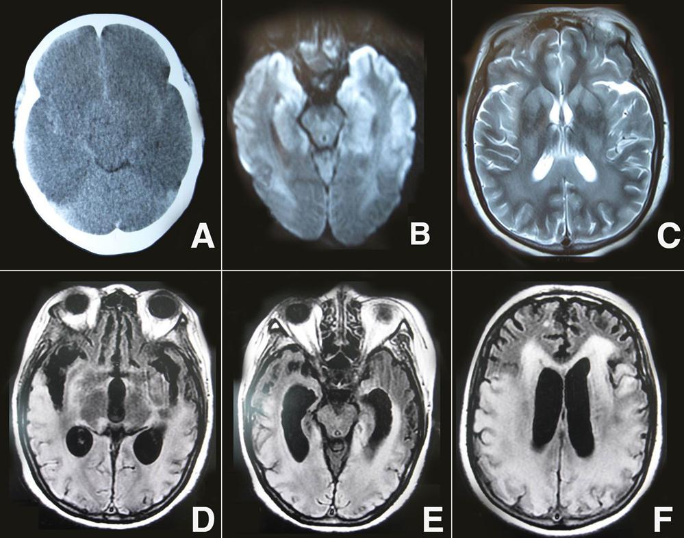 A) Brain CT showed a whole cerebral brain swelling, caudal transtentorial Herniation, and microhemorrhages in the intercerebral and subarachnoid; B) DWI showed extensive lesions of the bilateral middle, hippocampus and the gray matter of the frontal and temporal cortices; C) brain MRI T 2-weighted imaging showed bilateral symmetric high signal intensity in the caudate, putamen, thalami, occipital, parietal cortices and subcortical white matter; D-F) On follow-up MRI 60 days later, FLAIR showed cortical, subcortical white matter, and periventricular white matter confluent hyperintense lesions in the bilateral temporal, parietal, and occipital regions, and enlarged ventricles.