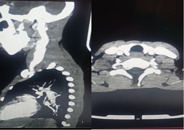 (c Left,d Right) (c) sagittal CT-image shows well-defined (d) axial CT-image showing dilated left IJV with homogenous huge left IJV