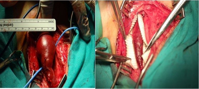 (f) intraoperative photograph shows a fusiform compressible dilatation IJVP. (g) intraoperative photograph shows the left vein wrapped in Dacron tube graft.