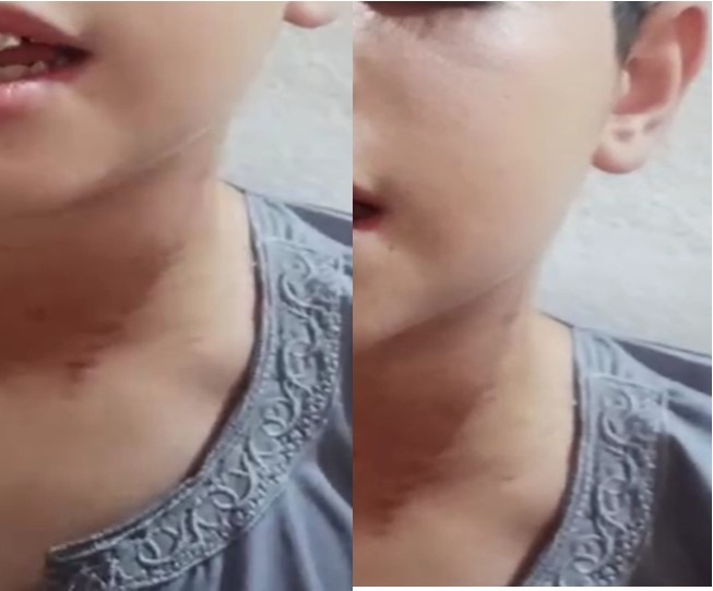 Complete recovery of neck mass with and without straining.