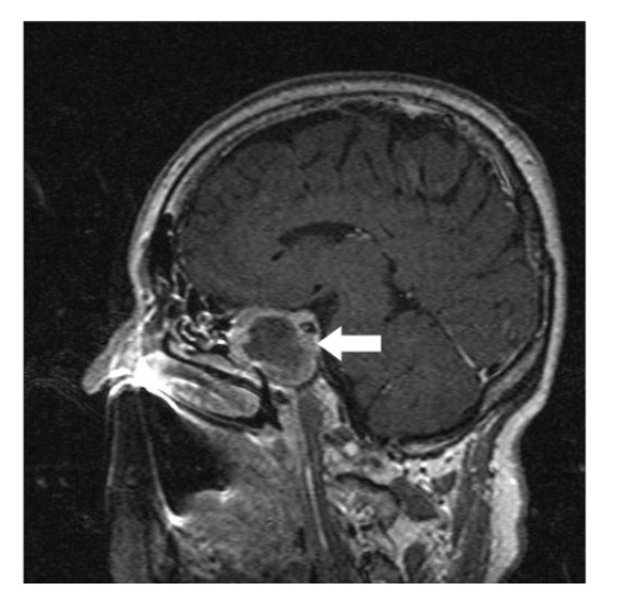 White arrow shows on sagittal section of MRI that a well-circumscribed contrast-enhancing lesion in the sella