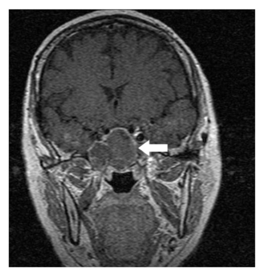 White arrow shows on coronal section of MRI that a well-circumscribed contrast-enhancing lesion in the sella