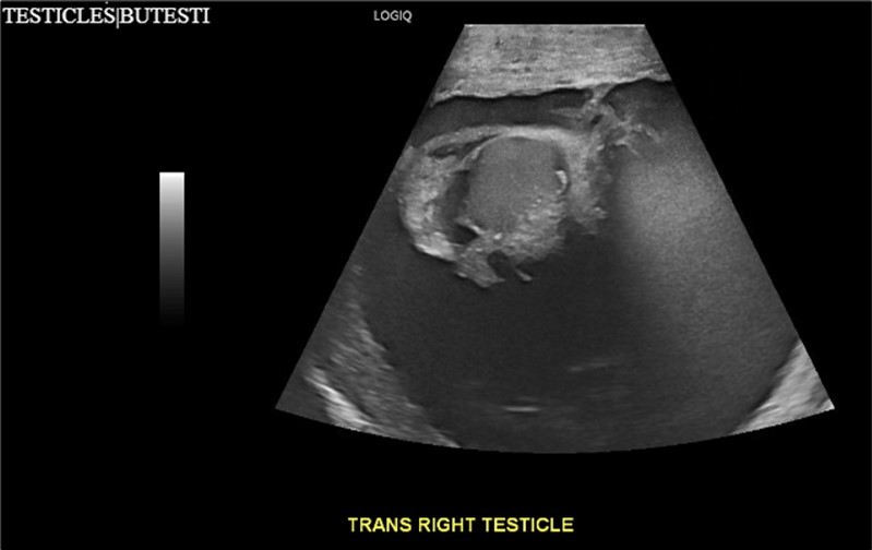 Ultrasound imaging in the transverse plane of the right testicle.