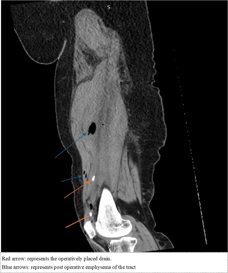 Sagittal cut of the non-contrasted CT of the femur – soft tissue