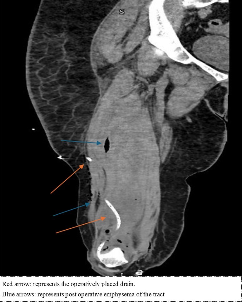 Coronal cut of the non-contrasted CT femur – soft tissue