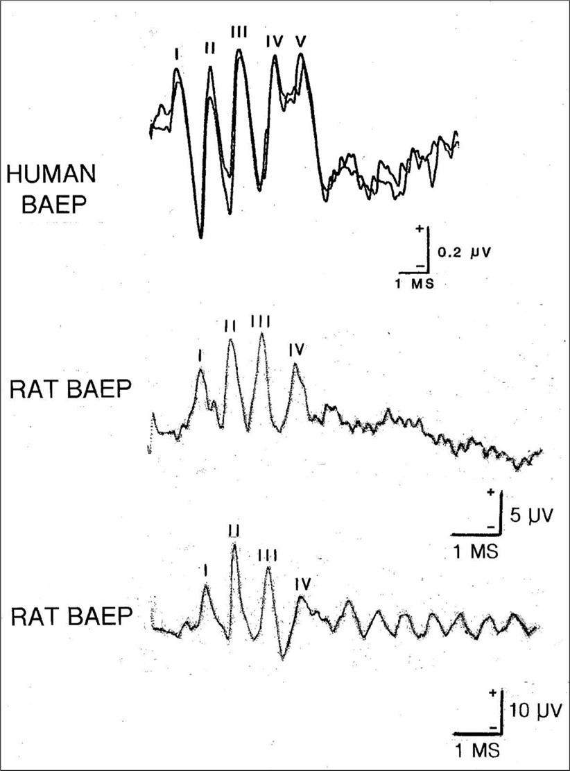 Three examples of the BAEP. In the upper illustration is a human BAEP with the five principal high frequency waves identified with Roman numerals. Note that in this example, the trace begins 0.5 msec after the stimulus. Two averages are superimposed to demonstrate reproducibility. In the middle illustration is a rat BAEP which like most small mammals consists of just four major waves. In the lower illustration is a second example of a rat BAEP. Note the train of lower amplitude wavelets which follow the principal components. BAEPs were recorded from a vertex electrode referred to an ipsilateral ear following monaural click stimulation delivered at a rate of 10/sec. The higher amplitude rodent waveform was due to the extradural skull screw electrode whereas the human BAEP was recorded using a subdermal needle meaning that the signal strength was much weaker.