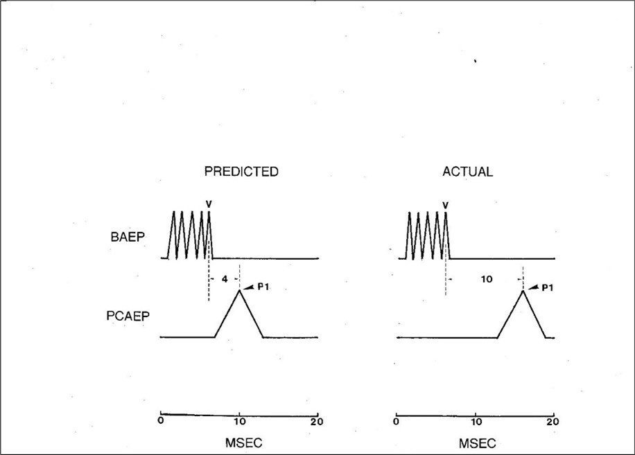 Schematic waveforms demonstrating the temporal relationship between the BAEP and the PCAEP in humans. The illustration on the left shows the PCAEP which would be predicted to occur based upon the assumption that wave V arises in the midbrain. Under these circumstances, the auditory signal is estimated to arrive at the primary auditory cortex ( P1 ) at approximately 10 msec. The illustration on the right shows the real temporal relationship between the BAEP and the PCAEP where the value of P1 is 16 msec. Note that the actual conduction time from wave V to P1 is therefore 2.5 times longer than the predicted conduction time.
