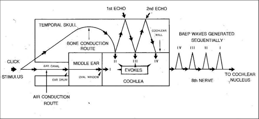 A schematic and simplified summary of the main features of the revised model of BAEP generation. According to this, each click elicits four separate sound waves which sequentially stimulate the cochlea. One of these is transmitted via the conventional air conduction route in the external auditory meatus. The remaining three are propagated via bone conduction in the temporal skull. Each, in turn, ultimately generates a compound action potential in the 8th nerve. Collectively, this successive activity creates the distinctive high frequency BAEP waveform.