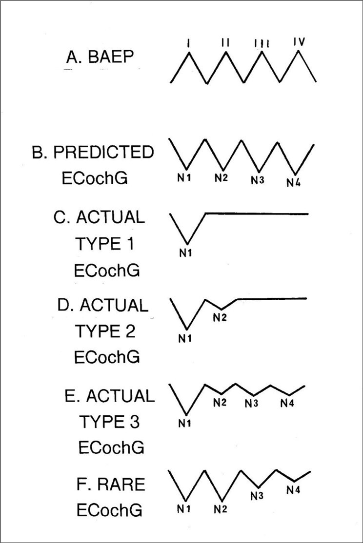 Traces A and B display the predicted relationship between the BAEP and the ECochG. In these, each positive BAEP wavelet has a negative counterpart in the ECochG and all the components in each waveform are approximately the same size as the initial one ( I or N1 ). Traces C, D, E and F demonstrate the main four varieties of the ECochG which are actually or routinely recorded. In all four examples, individual components are either missing or else attenuated when compared to hypothetical trace B. Note that these are artificial waveforms not derived from any data and no amplitude or latency scale applies.