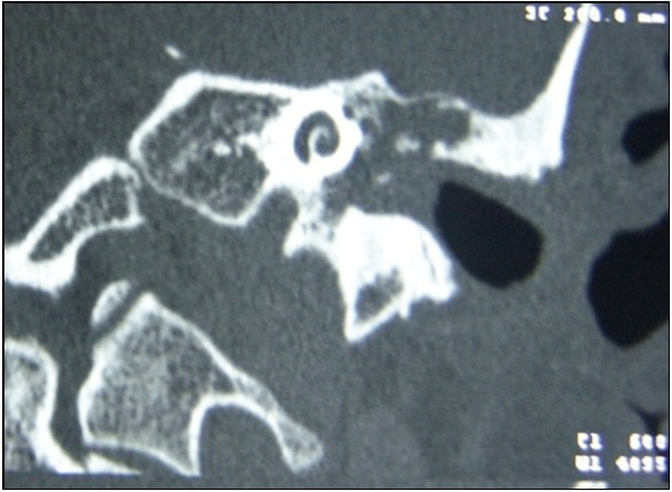 Soft tissue image causing bone erosion on temporal CT
