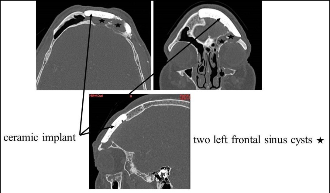 CT of the paranasal sinuses showed two left frontal sinus cysts. Black arrows: ceramic implant. Black stars: two left frontal sinus cysts