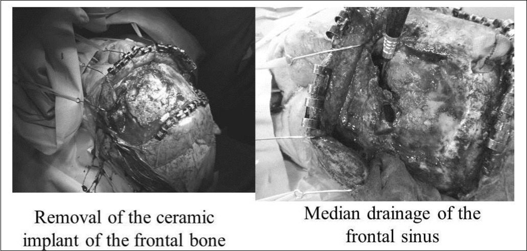 Craniotomy and median drainage. Left: Removal of the ceramic implant from the frontal bone. Right: Median drainage of the frontal sinus.