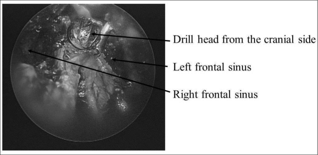Frontal sinus median drainage by nasal endoscopy. Drill head from the cranial side. The left and right frontal sinuses were opened.