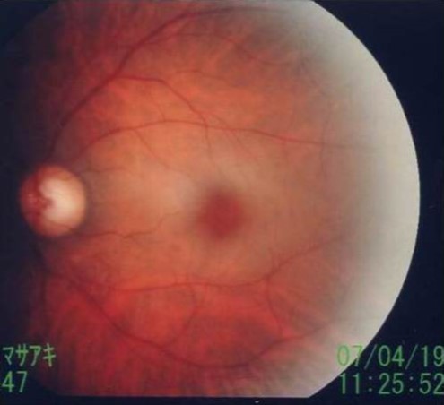 Cherry red spot. Funduscopy showed a cherry red spot.