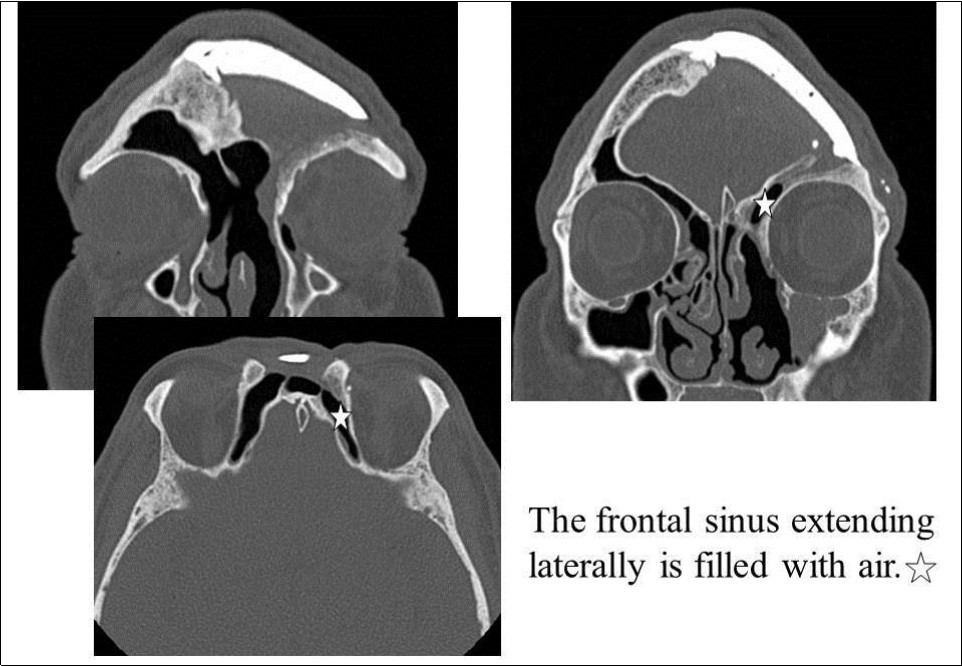 Paranasal sinus CT after the last surgery. White star: The frontal sinus extending laterally is filled with air.