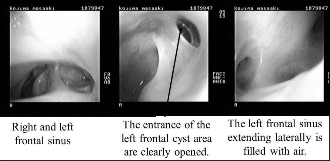 Endoscopic findings after surgery. Right and left frontal sinuses. The entrance of the left frontal cyst area is clearly opened (black arrow). The left frontal sinus extending laterally is filled with air.